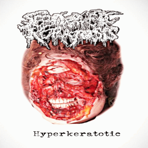 Seborrheic Keratosis : Hyperkeratotic